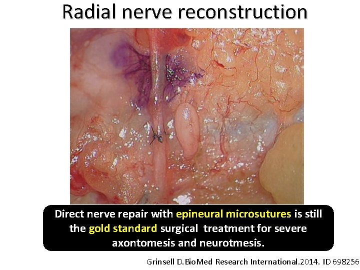 Radial nerve reconstruction Direct nerve repair with epineural microsutures is still the gold standard
