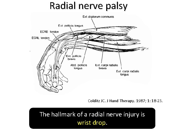 Radial nerve palsy Colditz JC. J Hand Therapy. 1987; 1: 18 -23. The hallmark