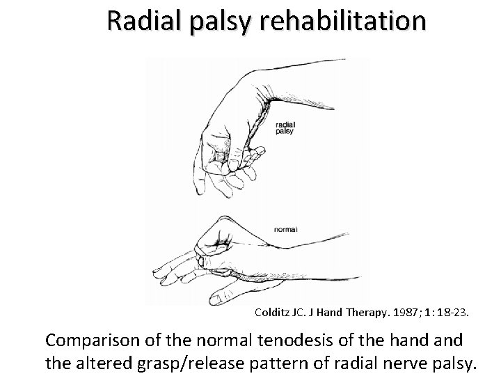 Radial palsy rehabilitation Colditz JC. J Hand Therapy. 1987; 1: 18 -23. Comparison of
