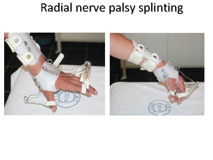 Radial nerve palsy splinting 