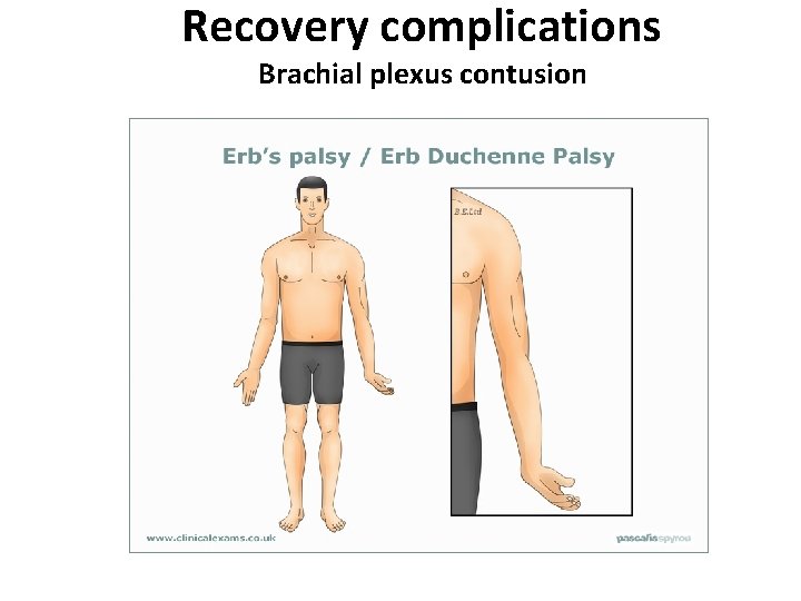 Recovery complications Brachial plexus contusion 
