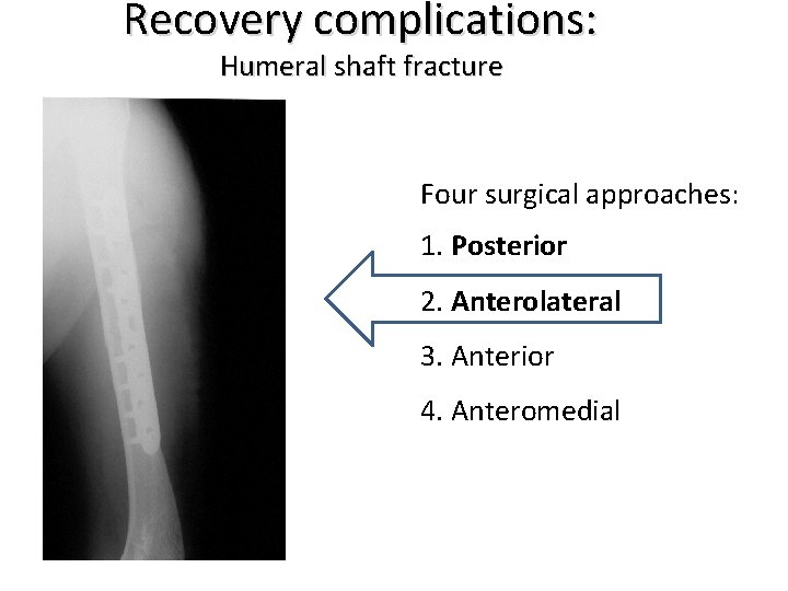 Recovery complications: Humeral shaft fracture Four surgical approaches: 1. Posterior 2. Anterolateral 3. Anterior