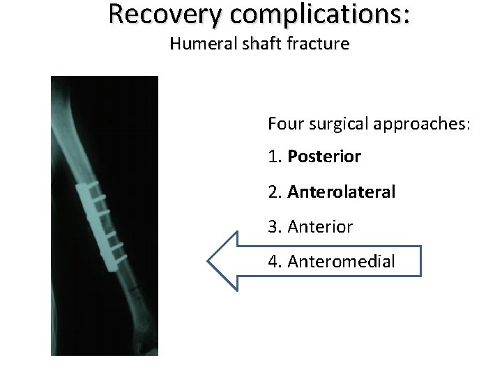 Recovery complications: Humeral shaft fracture Four surgical approaches: 1. Posterior 2. Anterolateral 3. Anterior
