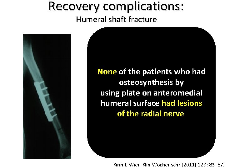 Recovery complications: Humeral shaft fracture None of the patients who had osteosynthesis by using
