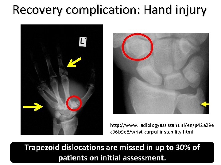 Recovery complication: Hand injury http: //www. radiologyassistant. nl/en/p 42 a 29 e c 06