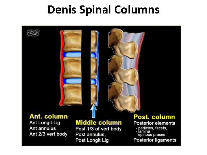 Denis Spinal Columns 