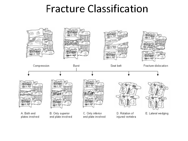 Fracture Classification 
