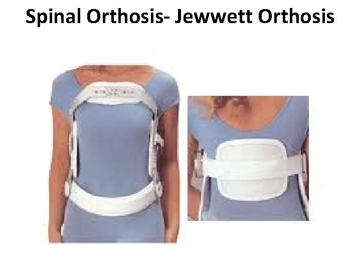 Spinal Orthosis- Jewwett Orthosis 