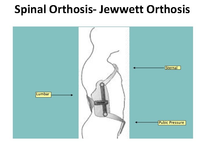 Spinal Orthosis- Jewwett Orthosis 