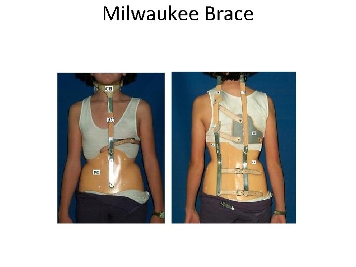Milwaukee Brace 