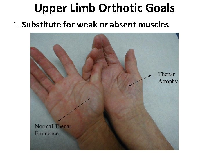 Upper Limb Orthotic Goals 1. Substitute for weak or absent muscles 