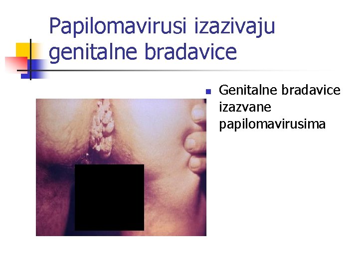 Papilomavirusi izazivaju genitalne bradavice n Genitalne bradavice izazvane papilomavirusima 