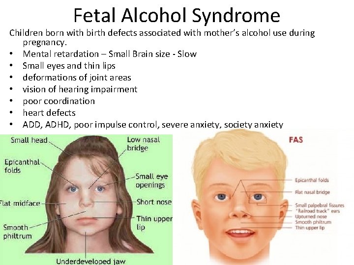 Fetal Alcohol Syndrome Children born with birth defects associated with mother’s alcohol use during