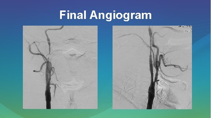 Dual stent deployment for the treatment plaque protrusion