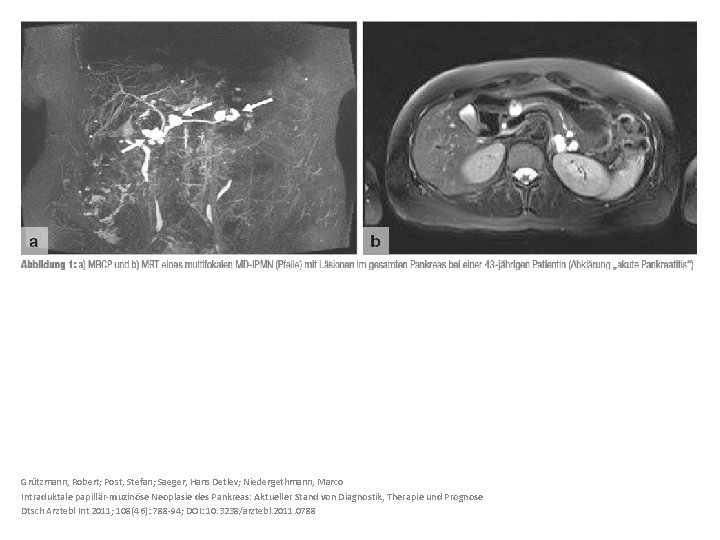 Grützmann, Robert; Post, Stefan; Saeger, Hans Detlev; Niedergethmann, Marco Intraduktale papillär-muzinöse Neoplasie des Pankreas: