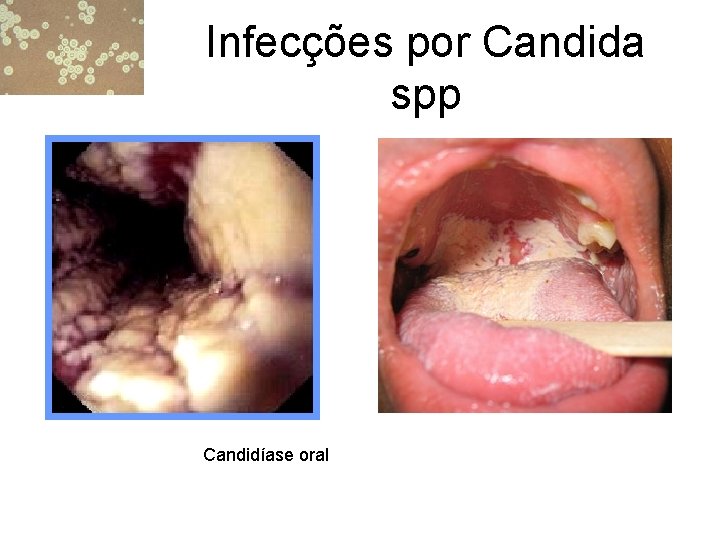 Infecções por Candida spp Candidíase oral 