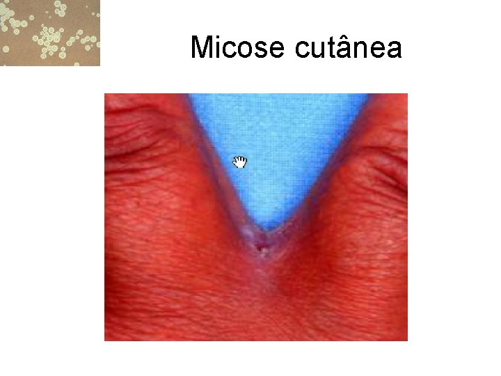 Micose cutânea 