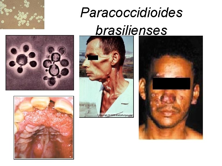 Paracoccidioides brasilienses 