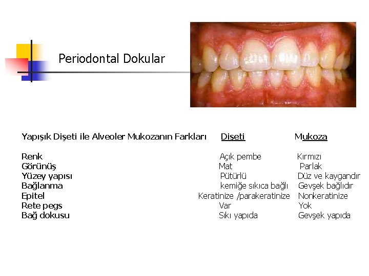 Periodontal Dokular Yapışık Dişeti ile Alveoler Mukozanın Farkları Renk Görünüş Yüzey yapısı Bağlanma Epitel