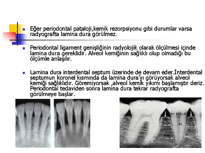 n n n Eğer periodontal pataloji, kemik rezorpsiyonu gibi durumlar varsa radyografta lamina dura