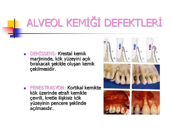 ALVEOL KEMİĞİ DEFEKTLERİ n n DEHİSSENS: Krestal kemik marjininde, kök yüzeyini açık bırakacak şekilde