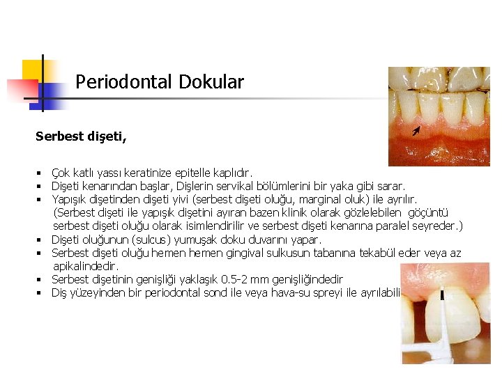 Periodontal Dokular Serbest dişeti, § Çok katlı yassı keratinize epitelle kaplıdır. § Dişeti kenarından