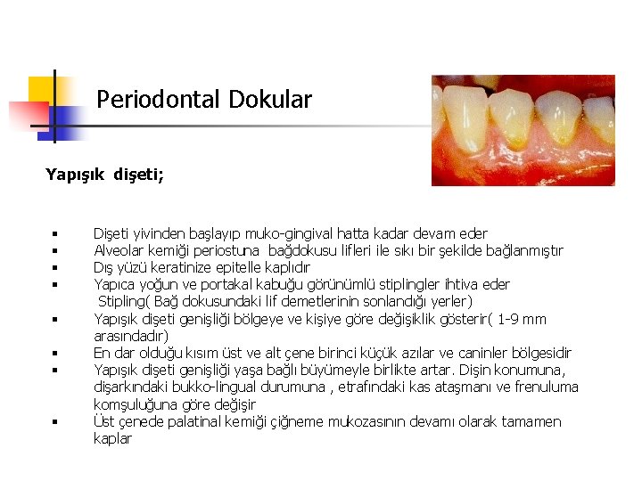 Periodontal Dokular Yapışık dişeti; § § § § Dişeti yivinden başlayıp muko-gingival hatta kadar