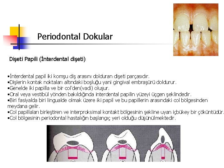 Periodontal Dokular Dişeti Papili (İnterdental dişeti) §İnterdental papil iki komşu diş arasını dolduran dişeti