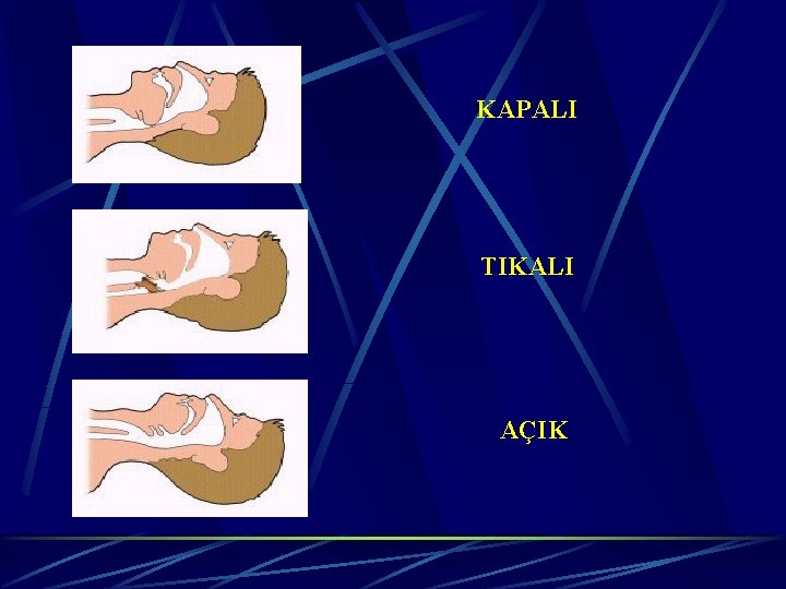 KAPALI TIKALI AÇIK 