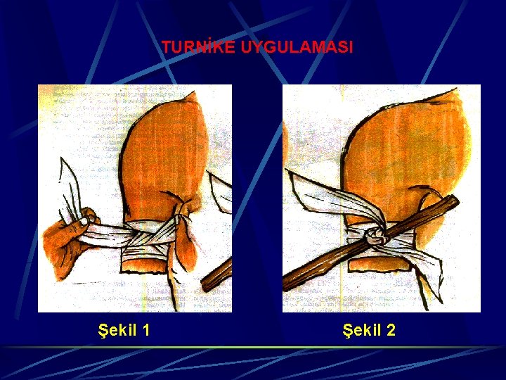 TURNİKE UYGULAMASI Şekil 1 Şekil 2 