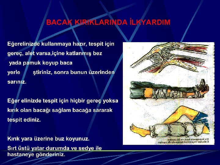 BACAK KIRIKLARINDA İLKYARDIM 