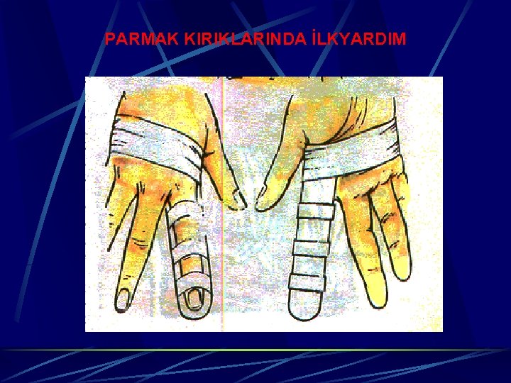 PARMAK KIRIKLARINDA İLKYARDIM 