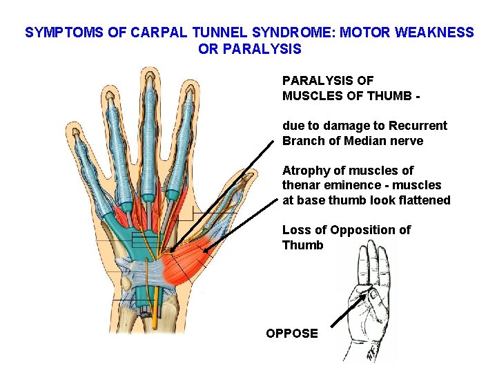 SYMPTOMS OF CARPAL TUNNEL SYNDROME: MOTOR WEAKNESS OR PARALYSIS OF MUSCLES OF THUMB due