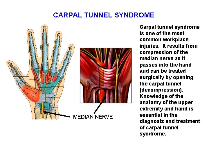 CARPAL TUNNEL SYNDROME MEDIAN NERVE Carpal tunnel syndrome is one of the most common