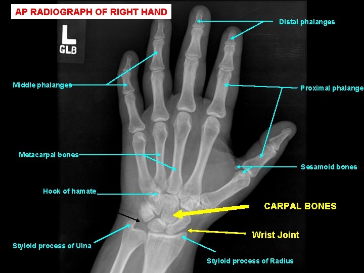 AP RADIOGRAPH OF RIGHT HAND Distal phalanges Middle phalanges Proximal phalanges Metacarpal bones Sesamoid