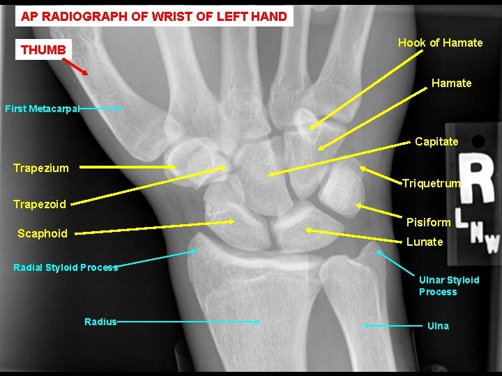 AP RADIOGRAPH OF WRIST OF LEFT HAND Hook of Hamate THUMB Hamate First Metacarpal