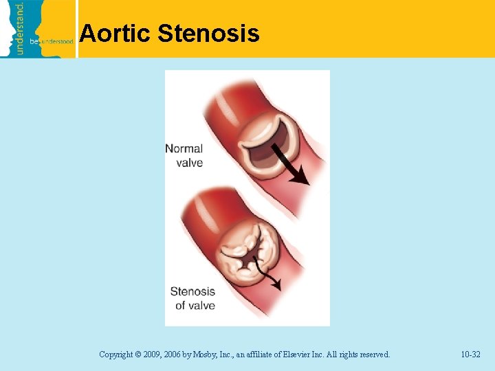 Aortic Stenosis Copyright © 2009, 2006 by Mosby, Inc. , an affiliate of Elsevier