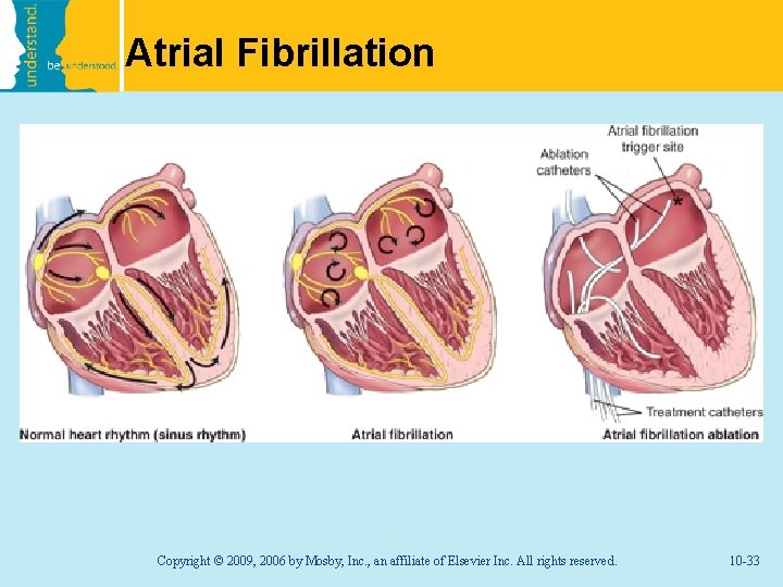 Atrial Fibrillation Copyright © 2009, 2006 by Mosby, Inc. , an affiliate of Elsevier