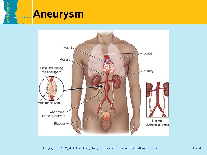 Aneurysm Copyright © 2009, 2006 by Mosby, Inc. , an affiliate of Elsevier Inc.