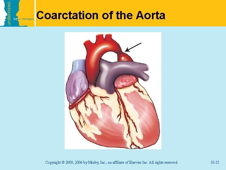 Coarctation of the Aorta Copyright © 2009, 2006 by Mosby, Inc. , an affiliate