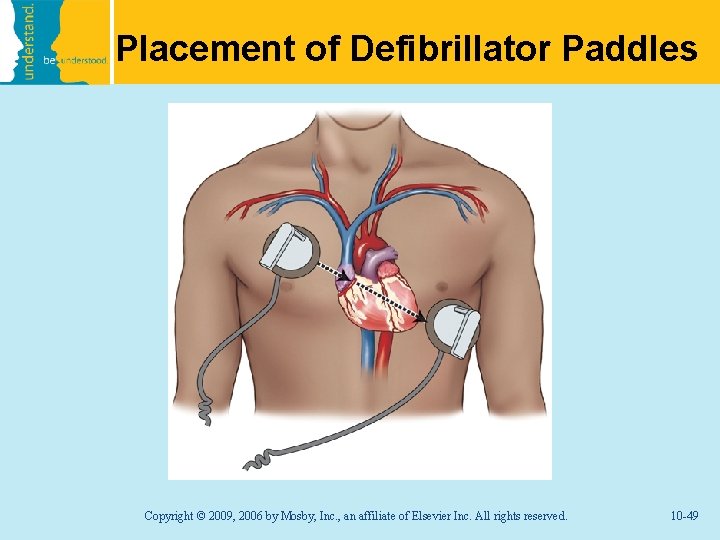 Placement of Defibrillator Paddles Copyright © 2009, 2006 by Mosby, Inc. , an affiliate