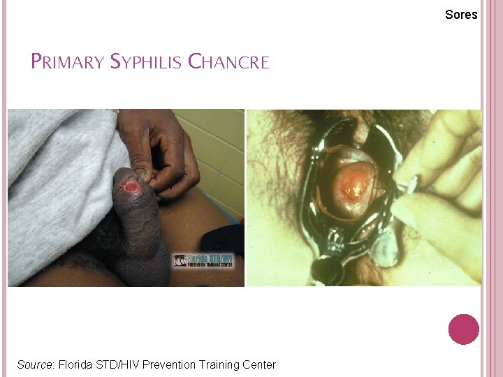 Sores PRIMARY SYPHILIS CHANCRE Source: Florida STD/HIV Prevention Training Center 