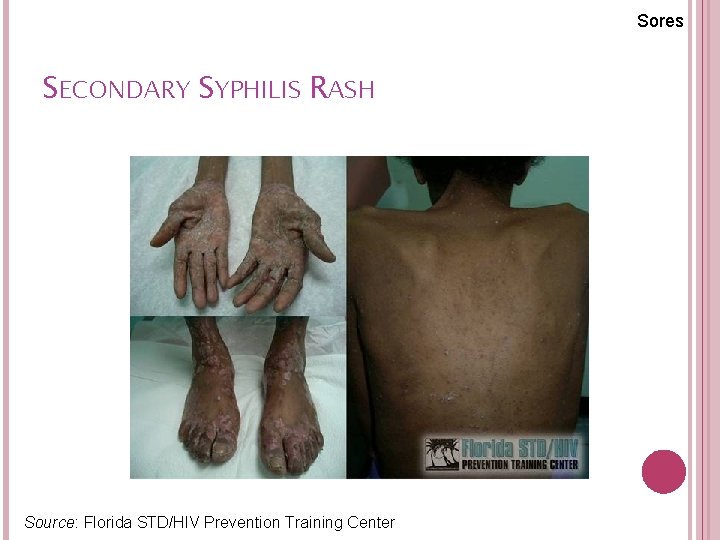 Sores SECONDARY SYPHILIS RASH Source: Florida STD/HIV Prevention Training Center 