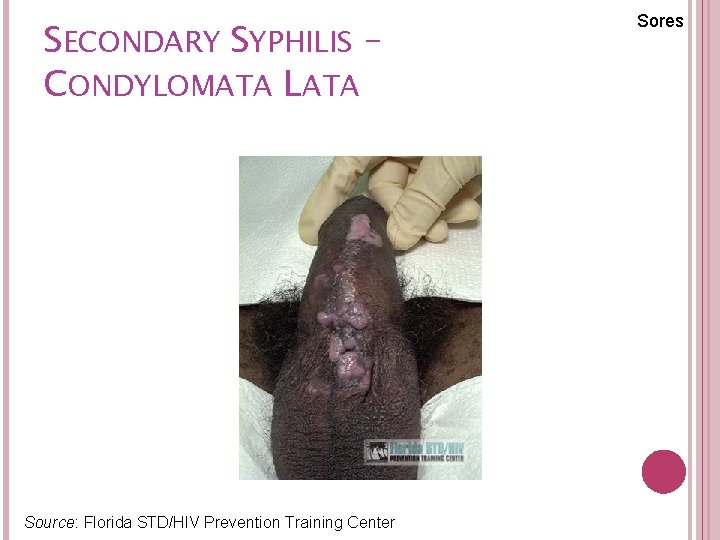SECONDARY SYPHILIS – CONDYLOMATA LATA Source: Florida STD/HIV Prevention Training Center Sores 