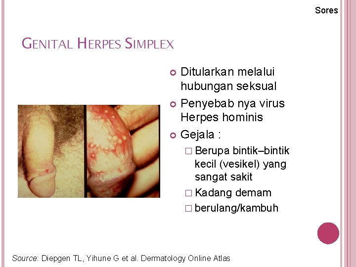 Sores GENITAL HERPES SIMPLEX Ditularkan melalui hubungan seksual Penyebab nya virus Herpes hominis Gejala