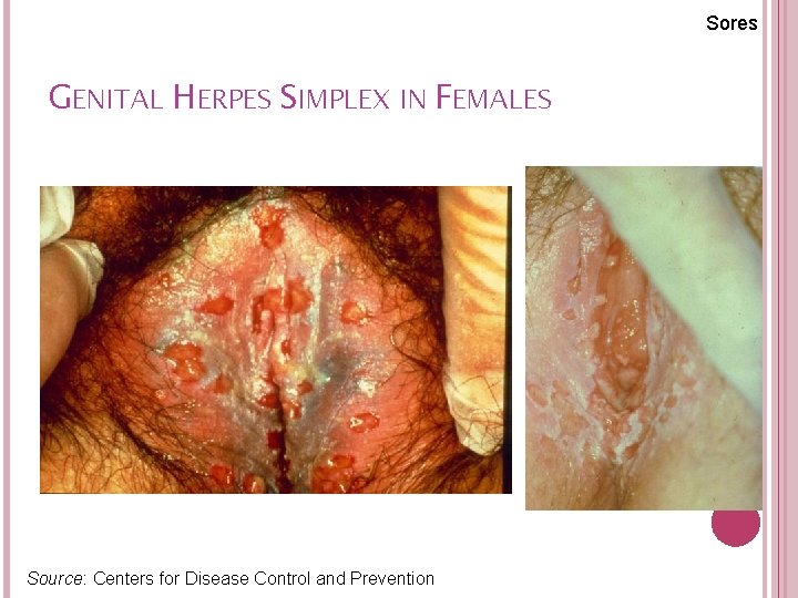 Sores GENITAL HERPES SIMPLEX IN FEMALES 47 Source: Centers for Disease Control and Prevention