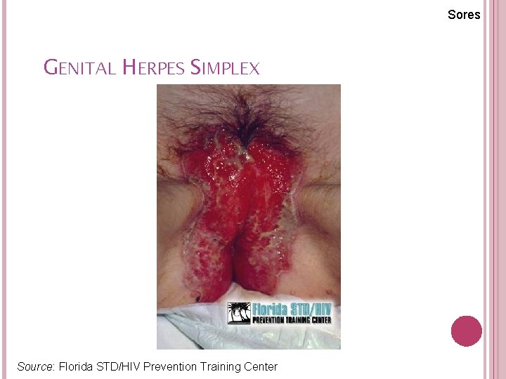 Sores GENITAL HERPES SIMPLEX Source: Florida STD/HIV Prevention Training Center 