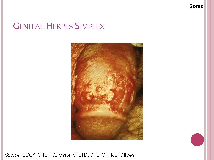 Sores GENITAL HERPES SIMPLEX Source: CDC/NCHSTP/Division of STD, STD Clinical Slides 