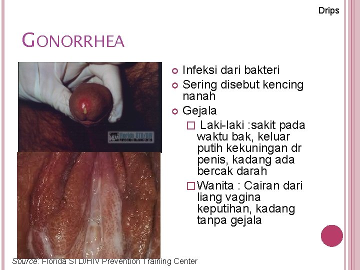 Drips GONORRHEA Infeksi dari bakteri Sering disebut kencing nanah Gejala � Laki-laki : sakit