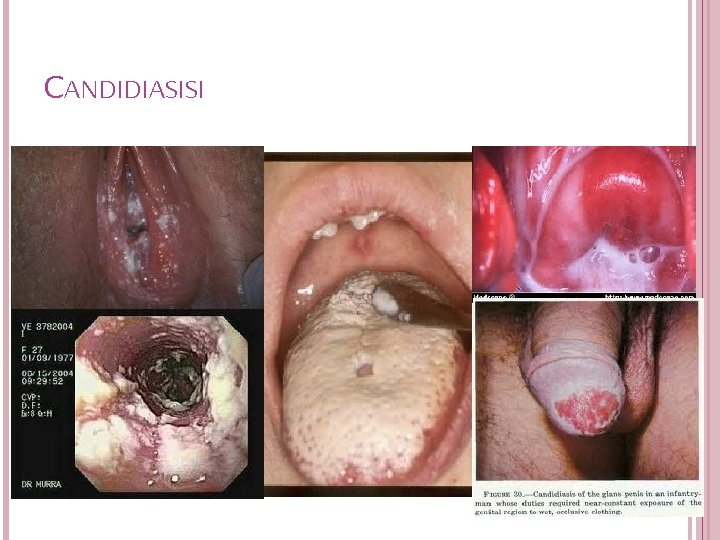 CANDIDIASISI 